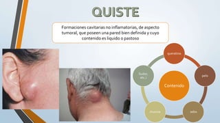Formaciones cavitarias no inflamatorias, de aspecto
tumoral, que poseen una pared bien definida y cuyo
contenido es liquido o pastoso
Contenido
queratina
pelo
sebomucina
Sudor,
etc.)
 