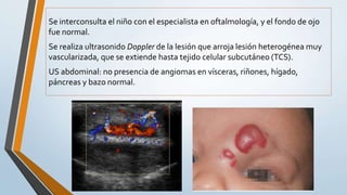 Se interconsulta el niño con el especialista en oftalmología, y el fondo de ojo
fue normal.
Se realiza ultrasonido Doppler de la lesión que arroja lesión heterogénea muy
vascularizada, que se extiende hasta tejido celular subcutáneo (TCS).
US abdominal: no presencia de angiomas en vísceras, riñones, hígado,
páncreas y bazo normal.
 