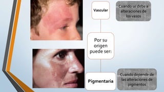 Por su
origen
puede ser:
Vascular
Pigmentaria
Cuando se debe a
alteraciones de
los vasos
Cuando depende de
las alteraciones de
pigmentos
 