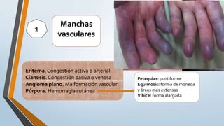 Eritema. Congestión activa o arterial
Cianosis. Congestión pasiva o venosa
Angioma plano. Malformación vascular
Púrpura. Hemorragia cutánea
Manchas
vasculares
1
Petequias: puntiforme
Equimosis: forma de moneda
y áreas más extensas
Víbice: forma alargada
 