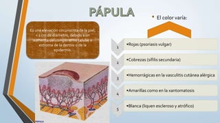 • El color varía:
1
•Rojas (psoriasis vulgar)
2
•Cobrezas (sífilis secundaria)
3
•Hemorrágicas en la vasculitis cutánea alérgica
4
•Amarillas como en la xantomatosis
5
•Blanca (liquen escleroso y atrófico)
Es una elevación circunscrita de la piel,
< 1 cm de diámetro, debido a un
aumento del componente celular o
estroma de la dermis o de la
epidermis.
 