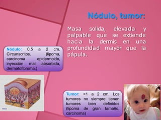 Nódulo, tumor:
elevada y
Masa solida,
palpable que se extiende
en una
que la
hacia la dermis
profundidad mayor
pápula.
Nódulo: 0.5
Circunscritos.
carcinoma
inyección mal
a 2 cm.
(lipoma,
epidermoide,
absorbida,
dermatofibroma.)
a 2 cm. Los
>1
no siempre tienen
Tumor:
tumores
tumores
(lipoma
bien
de gran
definidos
tamaño,
carcinoma)
 