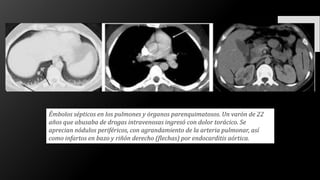 Émbolos sépticos en los pulmones y órganos parenquimatosos. Un varón de 22
años que abusaba de drogas intravenosas ingresó con dolor torácico. Se
aprecian nódulos periféricos, con agrandamiento de la arteria pulmonar, así
como infartos en bazo y riñón derecho (flechas) por endocarditis aórtica.
 