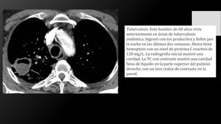 Tuberculosis. Este hombre de 68 años vivía
anteriormente en áreas de tuberculosis
endémica. Ingresó con tos productiva y fiebre por
la noche en las últimas dos semanas. Ahora tiene
hemoptisis con un nivel de proteína C reactiva de
120 mg/L. La radiografía inicial mostró una
cavidad. La TC con contraste mostró una cavidad
llena de líquido en la parte superior del pulmón
derecho, con un leve realce de contraste en la
pared.
 