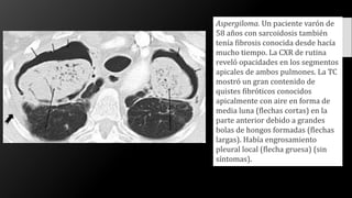 Aspergiloma. Un paciente varón de
58 años con sarcoidosis también
tenía fibrosis conocida desde hacía
mucho tiempo. La CXR de rutina
reveló opacidades en los segmentos
apicales de ambos pulmones. La TC
mostró un gran contenido de
quistes fibróticos conocidos
apicalmente con aire en forma de
media luna (flechas cortas) en la
parte anterior debido a grandes
bolas de hongos formadas (flechas
largas). Había engrosamiento
pleural local (flecha gruesa) (sin
síntomas).
 