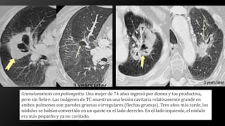 Granulomatosis con poliangeítis. Una mujer de 74 años ingresó por disnea y tos productiva,
pero sin fiebre. Las imágenes de TC muestran una lesión cavitaria relativamente grande en
ambos pulmones con paredes gruesas e irregulares (flechas gruesas). Tres años más tarde, los
nódulos se habían convertido en un quiste en el lado derecho. En el lado izquierdo, el nódulo
era más pequeño y ya no cavitado.
 