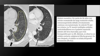 Nódulo reumático. Un varón de 46 años con
artritis reumatoide de larga evolución estaba
inmunosuprimido debido al tratamiento
continuo con metotrexato. Se solicitó TC por
tos crónica. La TC mostró múltiples nódulos
centrolobulillares en el pulmón izquierdo
(dentro del área marcada), que eran
bronquiolitis por su AR. Además, se observa un
nódulo cavitario subplueral (flecha gruesa). Un
mes después, el nódulo se estaba disipando
lentamente (flecha).
 