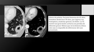 Cáncer de pulmón. Paciente femenina de 65 años,
fumadora desde hace 50 años, que ingresa con
hemoptisis y malestar general, sin fiebre. La TC
mostró una gran lesión cavitaria con paredes de
diferente grosor. Nótese que sin la historia clínica
este caso es imposible de diferenciar del caso
presentado.
 