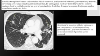 Las metástasis pulmonares de carcinomas de células escamosas, principalmente del tracto gastrointestinal y de mama,
sarcomas y adenocarcinomas frecuentemente cavitan . En las imágenes, puede ser difícil diferenciar los tumores
malignos de otras entidades cavitarias, pero la historia clínica de pérdida de peso y la ausencia de síntomas agudos,
como fiebre, pueden ser útiles.
Metástasis. Se muestran nódulos pulmonares
con componentes cavitarios pequeños y
grandes (flechas), que eran metástasis de un
adenocarcinoma en el páncreas (no se
muestra).
 