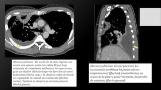 Absceso pulmonar. Mismo paciente. La
localización periférica ha provocado un
empiema local (flechas), y también hay un
realce de la pleura posteriormente, desarrollo
de empiema (flecha gruesa).
Absceso pulmonar . Un varón de 36 años ingresó con
sepsis una semana antes. Se realiza TC por baja
respuesta al tratamiento antibiótico. Se aprecia una
gran cavidad en el lóbulo superior derecho con nivel
hidroaéreo (flecha larga). Se observa realce del borde
en la pared de la cavidad anteriormente (flechas
cortas). También se observa un derrame pleural
(flecha gruesa).
 