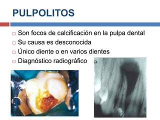 PULPOLITOS
 Son focos de calcificación en la pulpa dental
 Su causa es desconocida
 Único diente o en varios dientes
 Diagnóstico radiográfico
 