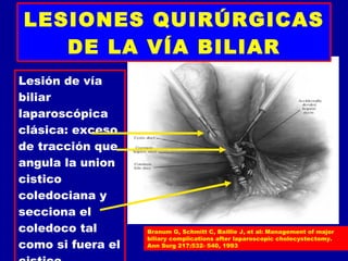 LESIONES QUIRÚRGICAS
   DE LA VÍA BILIAR
Lesión de vía
biliar
laparoscópica
clásica: exceso
de tracción que
angula la union
cistico
coledociana y
secciona el
coledoco tal       Branum G, Schmitt C, Baillie J, et al: Management of major
                   biliary complications after laparoscopic cholecystectomy.
como si fuera el   Ann Surg 217:532- 540, 1993
 