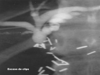 Exceso de clips
 