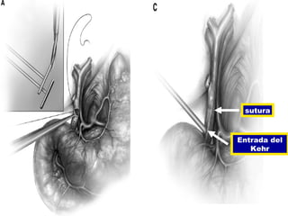 sutura



Entrada del
   Kehr
 