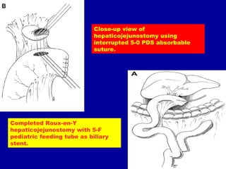 Close-up view of
                            hepaticojejunostomy using
                            interrupted 5-0 PDS absorbable
                            suture.




Completed Roux-en-Y
hepaticojejunostomy with 5-F
pediatric feeding tube as biliary
stent.
 