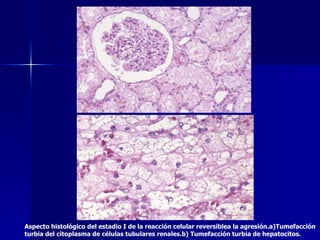 Aspecto histológico del estadio I de la reacción celular reversiblea la agresión.a)Tumefacción turbia del citoplasma de células tubulares renales.b) Tumefacción turbia de hepatocitos. 