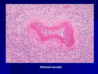Fibrinoid necrosis  