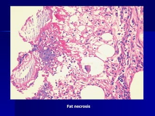 Fat necrosis  