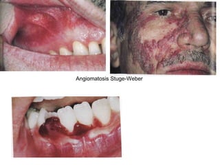 Angiomatosis Stuge-Weber
