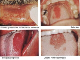 Eritema y erosiones por radiación ionizante Felación Lengua geográfica Glositis romboidal media