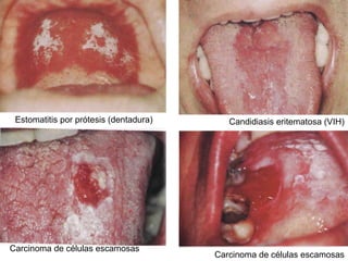 Candidiasis eritematosa (VIH) Estomatitis por prótesis (dentadura) Carcinoma de células escamosas Carcinoma de células escamosas