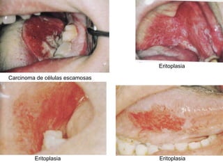 Carcinoma de células escamosas Eritoplasia Eritoplasia Eritoplasia
