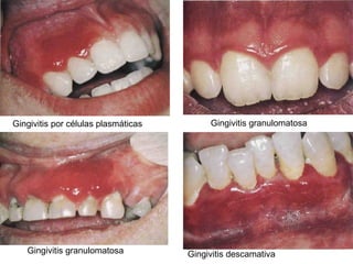 Gingivitis por células plasmáticas Gingivitis granulomatosa Gingivitis granulomatosa Gingivitis descamativa