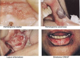 Hemangioma capilar Hemangioma cavernoso Lupus eritematoso Síndrome CREST
