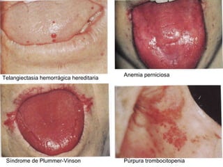 Telangiectasia hemorrágica hereditaria Anemia perniciosa Síndrome de Plummer-Vinson Púrpura trombocitopenia