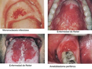Mononucleosis infecciosa Enfermedad de Reiter Enfermedad de Reiter Ameloblastoma periférico