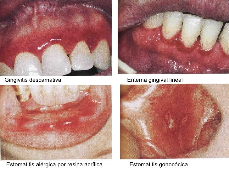 Manchas Rojas En La Boca Lesiones Rojas