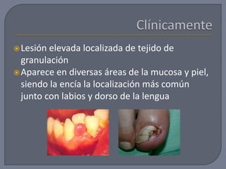 Lesión elevada localizada de tejido de
granulación
Aparece en diversas áreas de la mucosa y piel,
siendo la encía la localización más común
junto con labios y dorso de la lengua
 