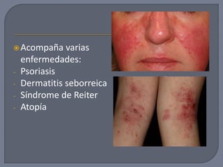 Acompaña varias
enfermedades:
- Psoriasis
- Dermatitis seborreica
- Síndrome de Reiter
- Atopía
 
