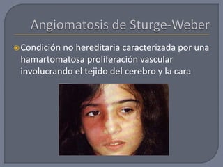 Condición no hereditaria caracterizada por una
hamartomatosa proliferación vascular
involucrando el tejido del cerebro y la cara
 