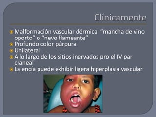  Malformación vascular dérmica “mancha de vino
oporto” o “nevo flameante”
 Profundo color púrpura
 Unilateral
 A lo largo de los sitios inervados pro el IV par
craneal
 La encía puede exhibir ligera hiperplasia vascular
 