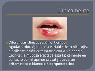  Diferencias clínicas según el tiempo:
- Aguda: ardor. Apariencia variable de media rojiza
a brillante lesión eritematosa con o sin edema
- Crónica: la mucosa afectada está típicamente en
contacto con el agente causal y puede ser
eritematoso o blanco e hiperqueratósico
 