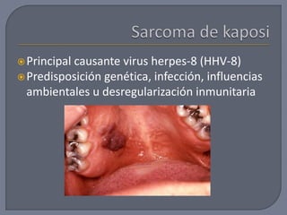 Principal causante virus herpes-8 (HHV-8)
Predisposición genética, infección, influencias
ambientales u desregularización inmunitaria
 