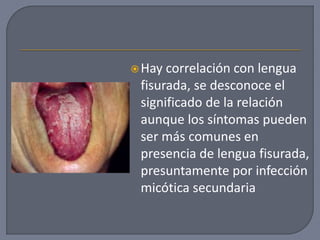 Hay correlación con lengua
fisurada, se desconoce el
significado de la relación
aunque los síntomas pueden
ser más comunes en
presencia de lengua fisurada,
presuntamente por infección
micótica secundaria
 