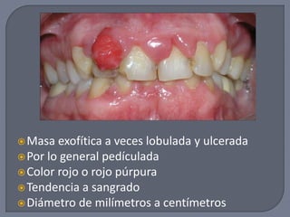 Masa exofítica a veces lobulada y ulcerada
Por lo general pedículada
Color rojo o rojo púrpura
Tendencia a sangrado
Diámetro de milímetros a centímetros
 