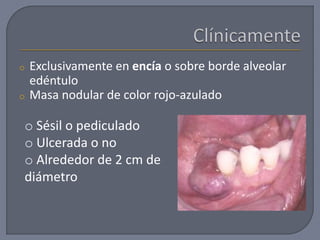 o Exclusivamente en encía o sobre borde alveolar
edéntulo
o Masa nodular de color rojo-azulado
o Sésil o pediculado
o Ulcerada o no
o Alrededor de 2 cm de
diámetro
 