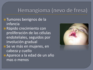 Tumores benignos de la
infancia
Rápido crecimiento con
proliferación de las células
endoteliales, seguidos por
involución gradual
Se ve más en mujeres, en
cabeza y cuello
Aparece a la edad de un año
mas o menos
 