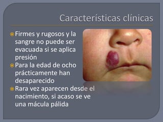 Firmes y rugosos y la
sangre no puede ser
evacuada si se aplica
presión
Para la edad de ocho
prácticamente han
desaparecido
Rara vez aparecen desde el
nacimiento, si acaso se ve
una mácula pálida
 