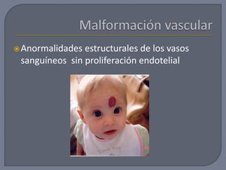 Anormalidades estructurales de los vasos
sanguíneos sin proliferación endotelial
 