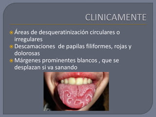  Áreas de desqueratinización circulares o
irregulares
 Descamaciones de papilas filiformes, rojas y
dolorosas
 Márgenes prominentes blancos , que se
desplazan si va sanando
 