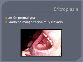 Lesión premaligna
Grado de malignización muy elevado
 