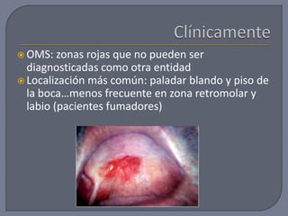  OMS: zonas rojas que no pueden ser
diagnosticadas como otra entidad
 Localización más común: paladar blando y piso de
la boca…menos frecuente en zona retromolar y
labio (pacientes fumadores)
 