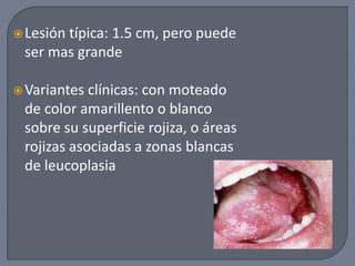 Lesión típica: 1.5 cm, pero puede
ser mas grande
Variantes clínicas: con moteado
de color amarillento o blanco
sobre su superficie rojiza, o áreas
rojizas asociadas a zonas blancas
de leucoplasia
 