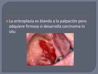 La eritroplasia es blanda a la palpación pero
adquiere firmeza si desarrolla carcinoma in
situ
 