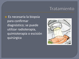  Es necesaria la biopsia
para confirmar
diagnóstico; se puede
utilizar radioterapia,
quimioterapia o escisión
quirúrgica
 