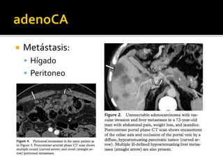  Metástasis:
 Hígado
 Peritoneo
 